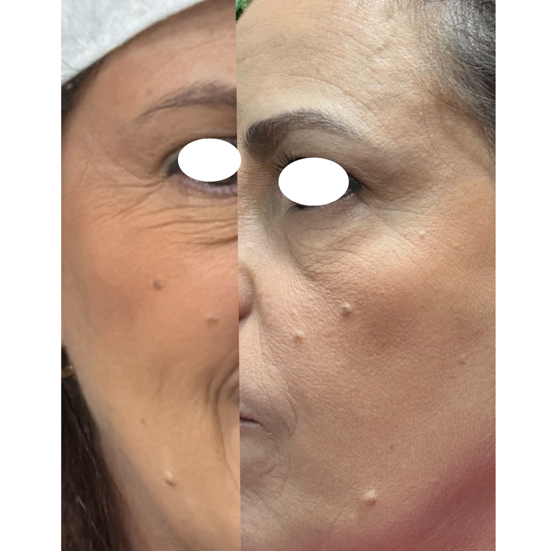 Essencial Olhos - Nano Lifting Redutor de Olheiras e Rugas