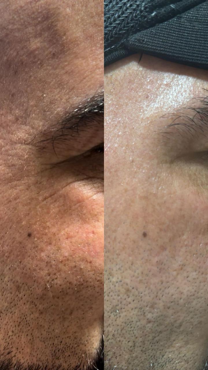 Creme Anti-Idade ASK com 10 tipos de Ácido Hialurônico Facial e Pescoço 30g