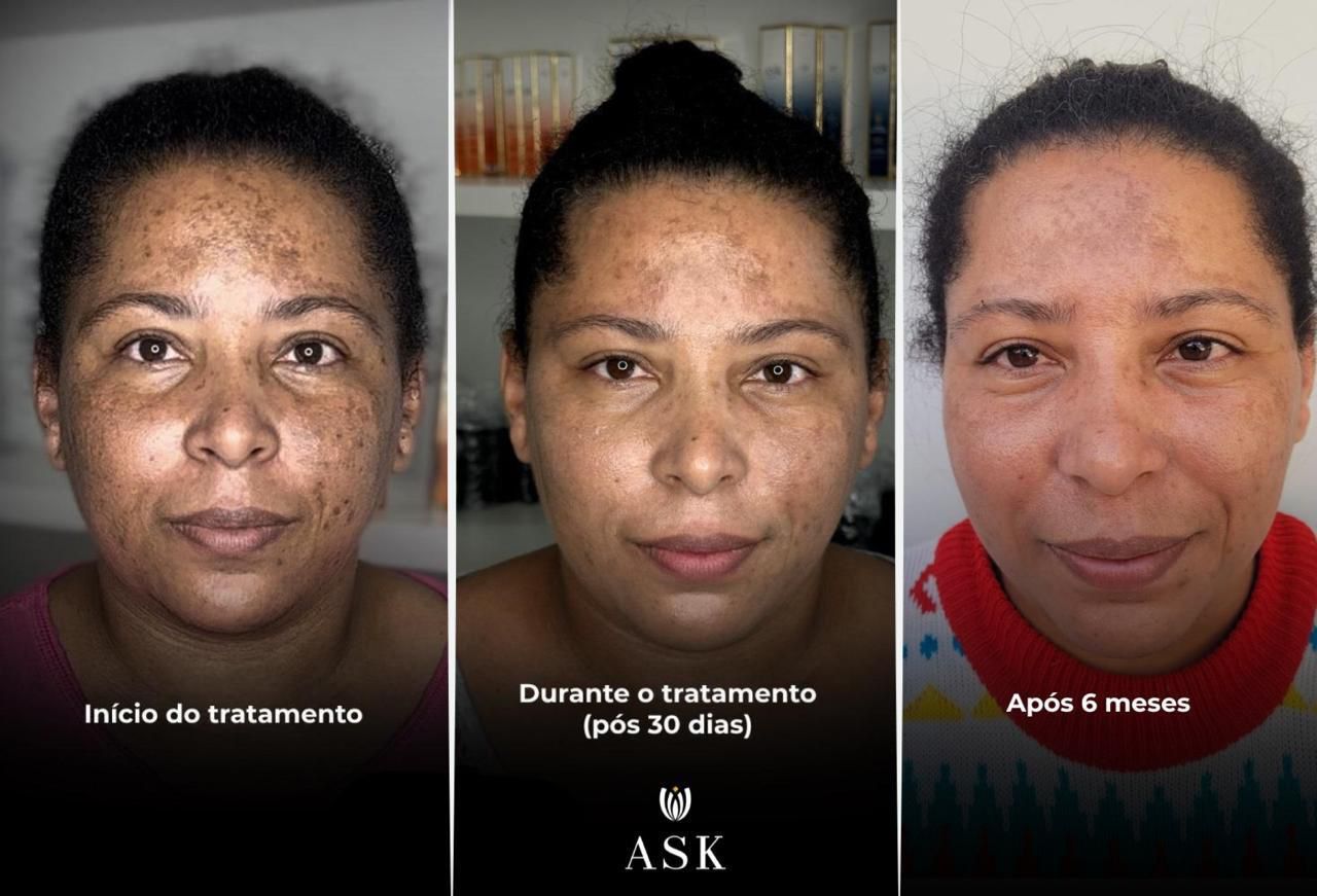Sérum Clareador de Manchas e Melasma ASK Dermocosméticos