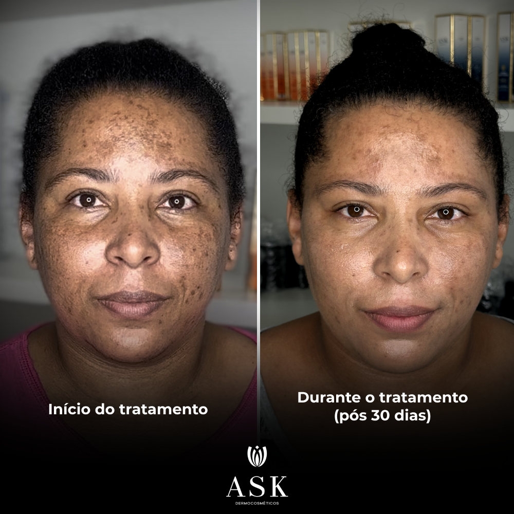 Kit Clareador de Melasma e Manchas